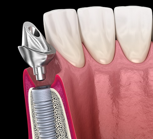 A 3D illustration of a dental implant abutment
