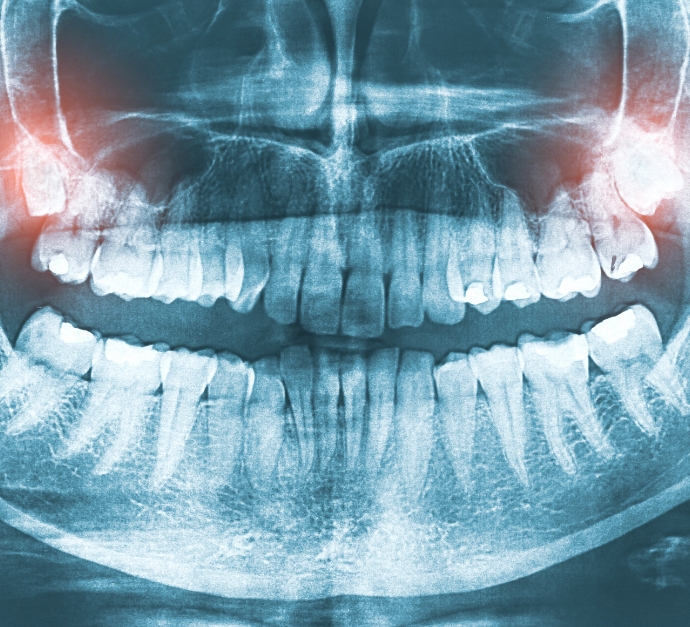 X ray of teeth with the wisdom teeth highlighted red
