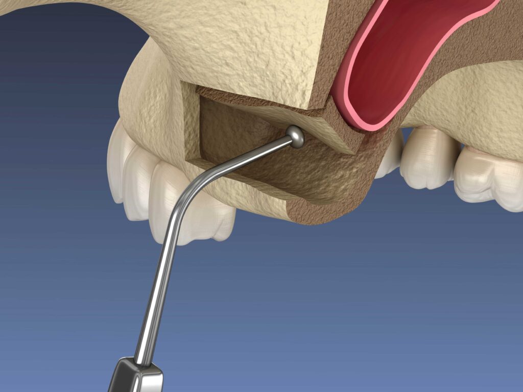 Digital illustration of a sinus lift